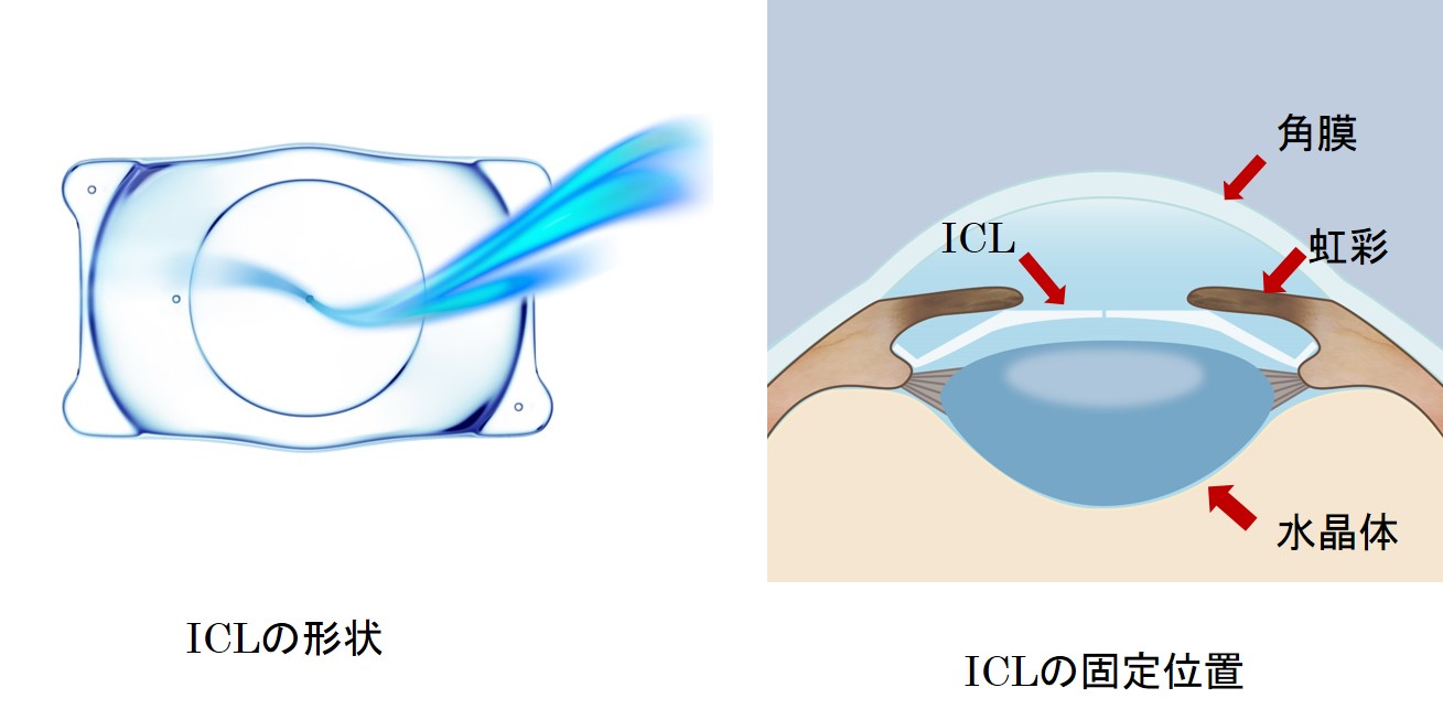 と icl は 手術