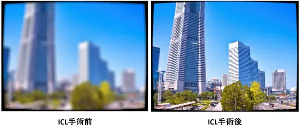 図3 ICL手術を受ける前と受けた後の見え方の違い