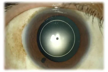 図4 ICL手術後の前眼部写真